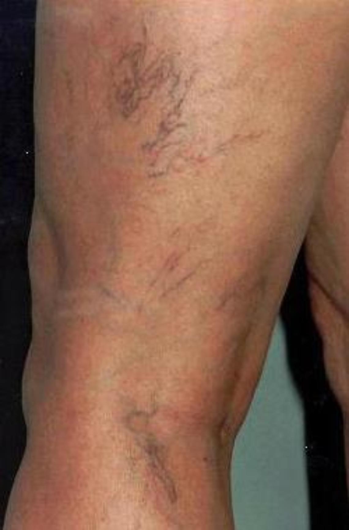 vena varicosa