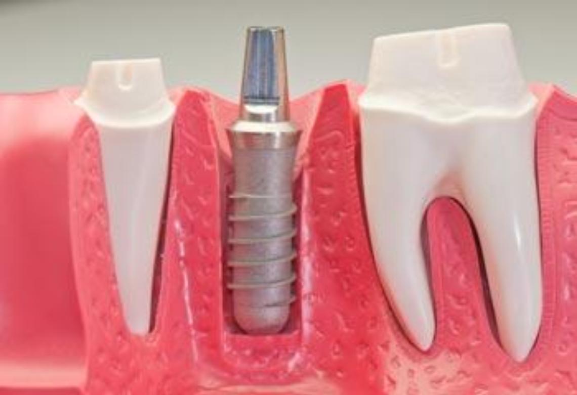 implantologia-dentale-1