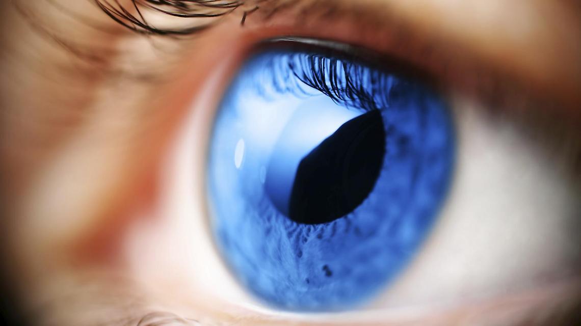 glaucoma