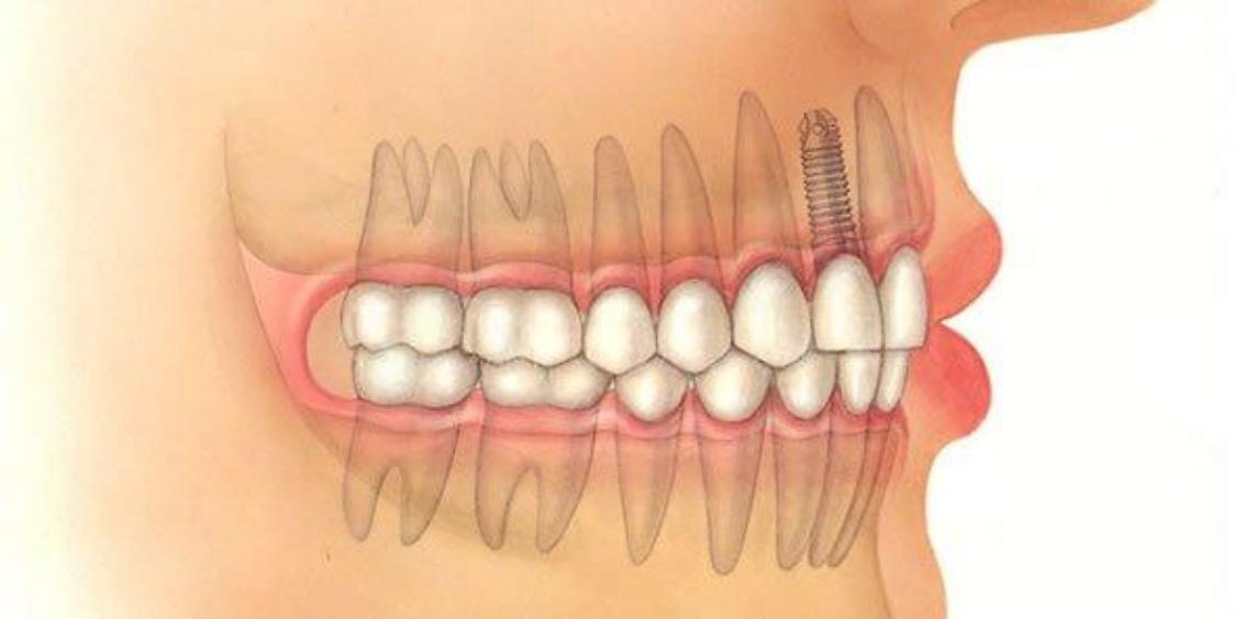 implantologia-dentale