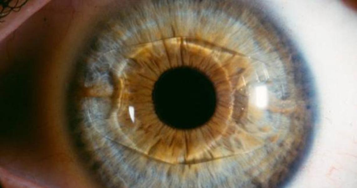 lenti-intraoculari