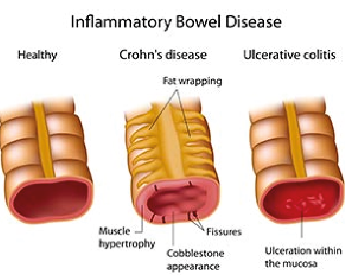 disbiosi-intestinale