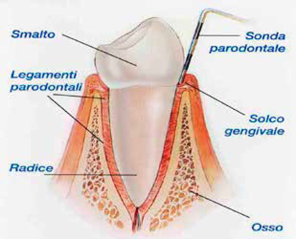 piorrea