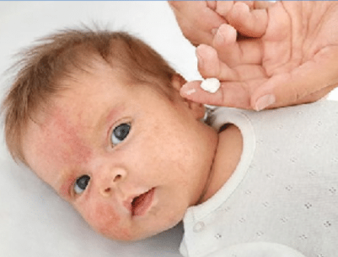 dermatite neonato