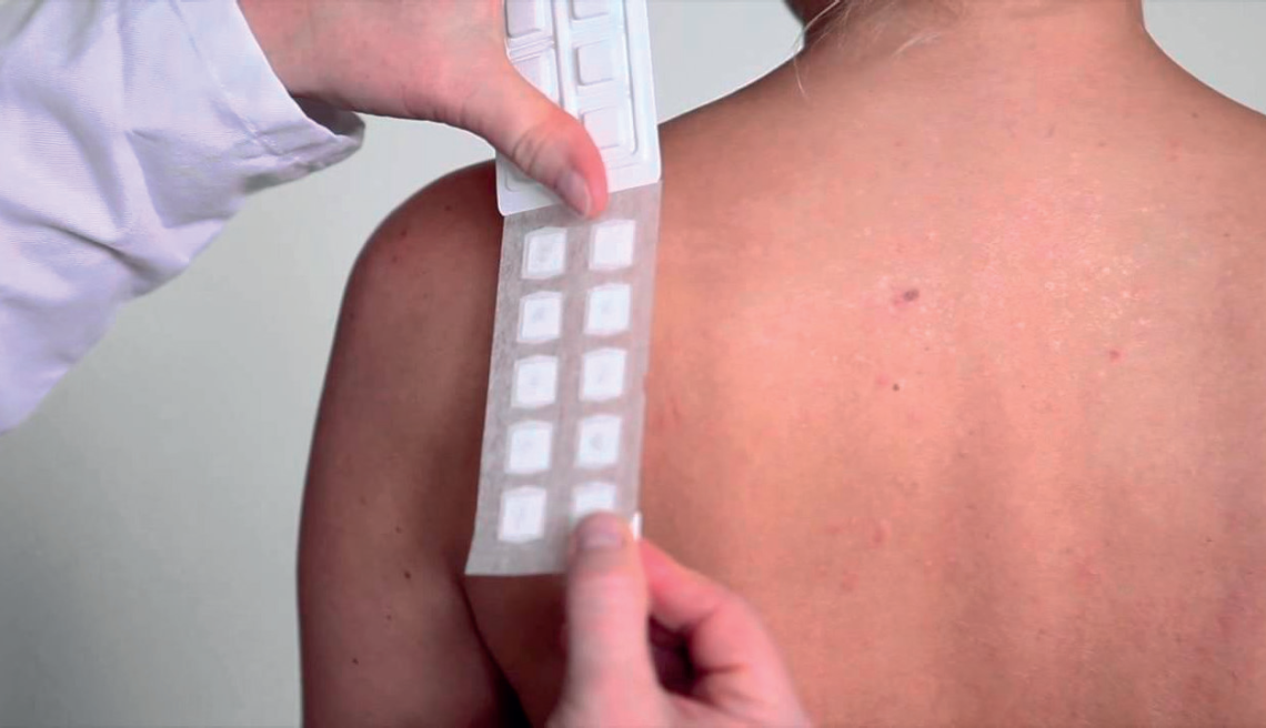 patch test dermatite