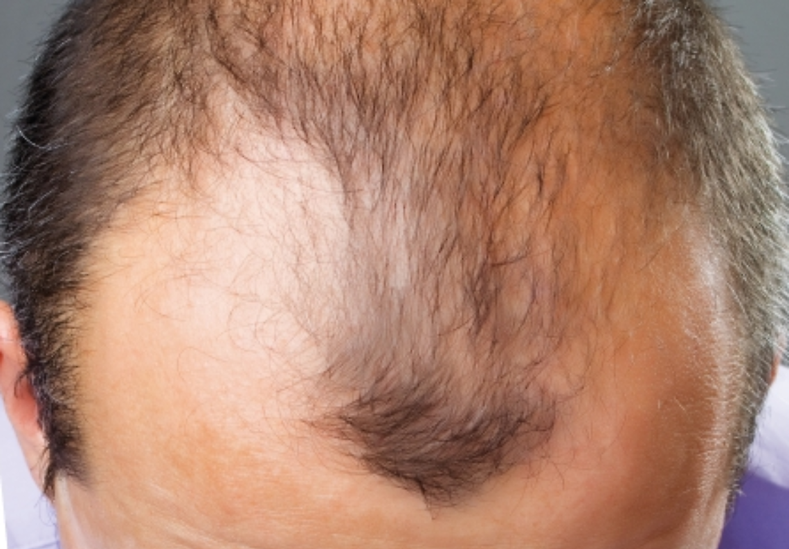 Autotrapianto di Capelli: Soluzione Definitiva o Solo un Passo?