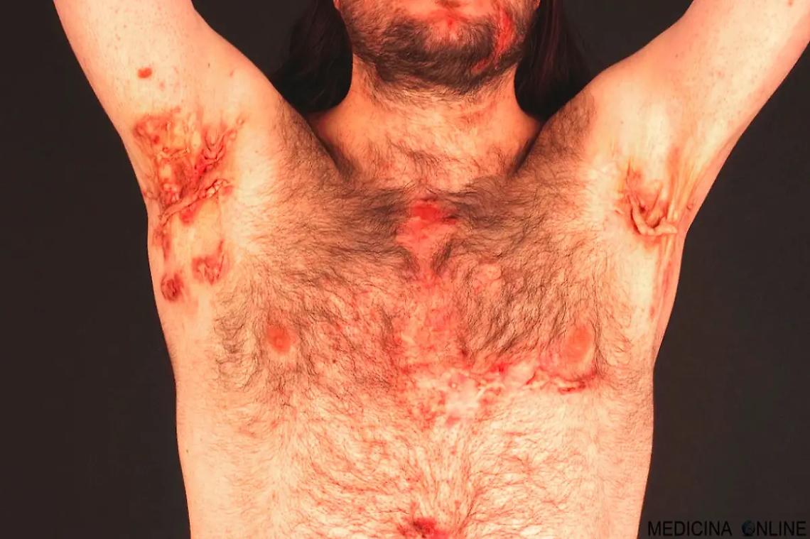 I sintomi della malattia