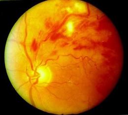 Le trombosi venose retiniche