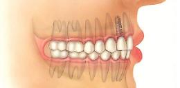 Implantologia dentale: quando e come praticarla