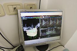 Implantologia computer guidata in Odontoiatria
