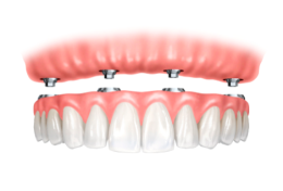 Carico immediato: torna a sorridere con Vitaldent
