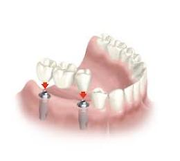 Carico immediato: torna a sorridere con Vitaldent