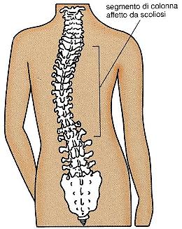 Scoliosi - Cause, sintomi, fattori di rischio e diagnosi