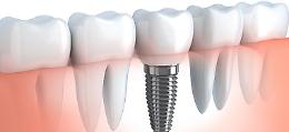 Importanti novità  nella Chirugia implantare