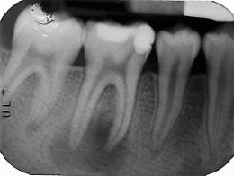 Quando il trattamento endodontico diventa necessario
