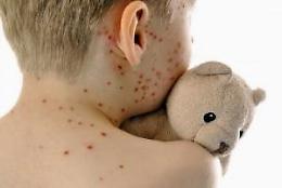 Picco di casi di morbillo in Veneto: la situazione è sotto controllo