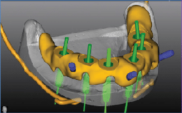La Tac dentale Cone Beam (ricostruzioni 3D)