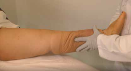 Gambe gonfie in estate: sintomi, rimedi e quando rivolgersi al medico