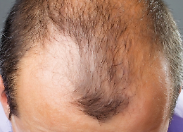 Oltre l'autotrapianto: la rivoluzione nella cura dei capelli