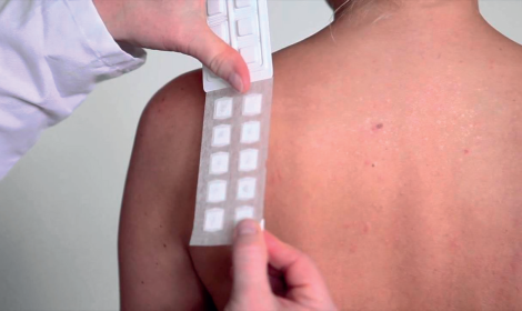 patch test dermatite
