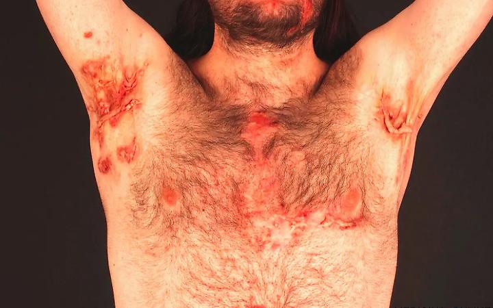 I sintomi della malattia